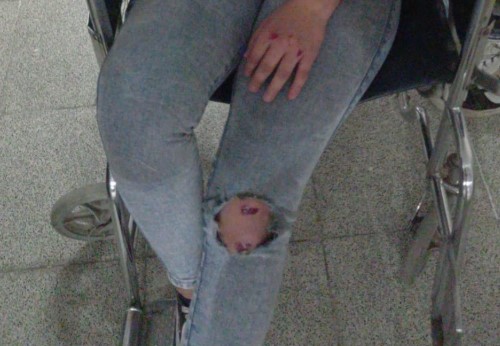Denuncia Pública: Joven herida en un nuevo accidente vial en Santa Rosa, señala negligencia del conductor y maltrato policial y hospitalario